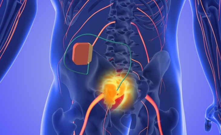 Μεσοπλεύρια νευραλγία