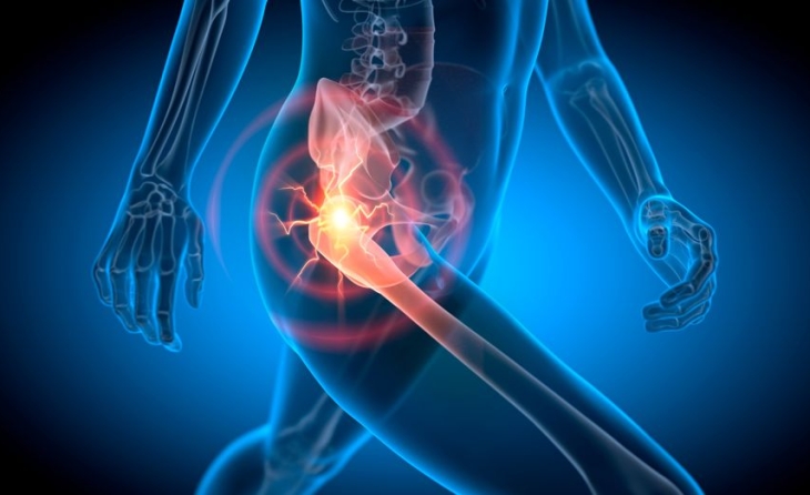 Οσφυική ριζίτιδα