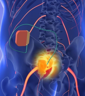 Αποκλεισμός άνω υπογάστριου πλέγματος