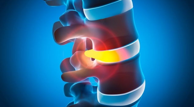 Κυφοπλαστική