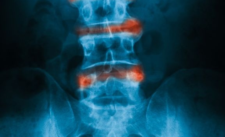 Επισκληρίδιες εγχύσεις