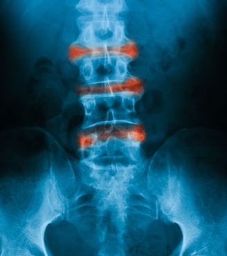 Επισκληρίδιες εγχύσεις