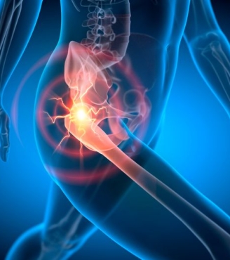 Οστεοαρθρίτιδα ισχίου