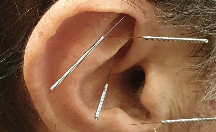 Βελονισμός